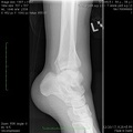 T Ankle joint a.p. Lt3