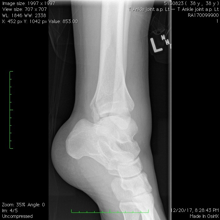 T Ankle joint a.p. Lt3.jpg