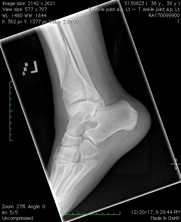 T Ankle joint a.p. Lt4.jpg
