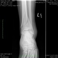 T Ankle joint a.p. Lt.jpg