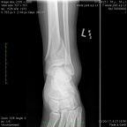 T Ankle joint a.p. Lt