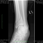 T Ankle joint a.p. Lt2