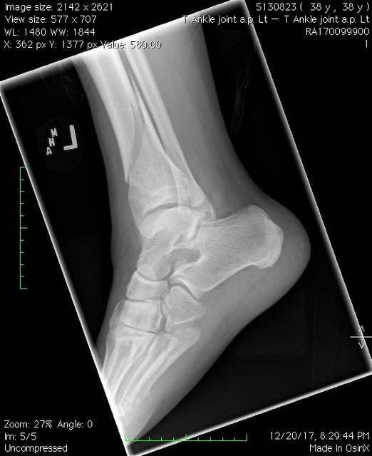 T Ankle joint a.p. Lt4