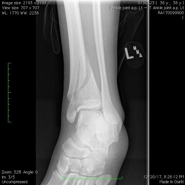T Ankle joint a.p. Lt2.jpg